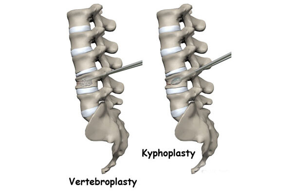 Kyphoplasty/Vertebroplasty