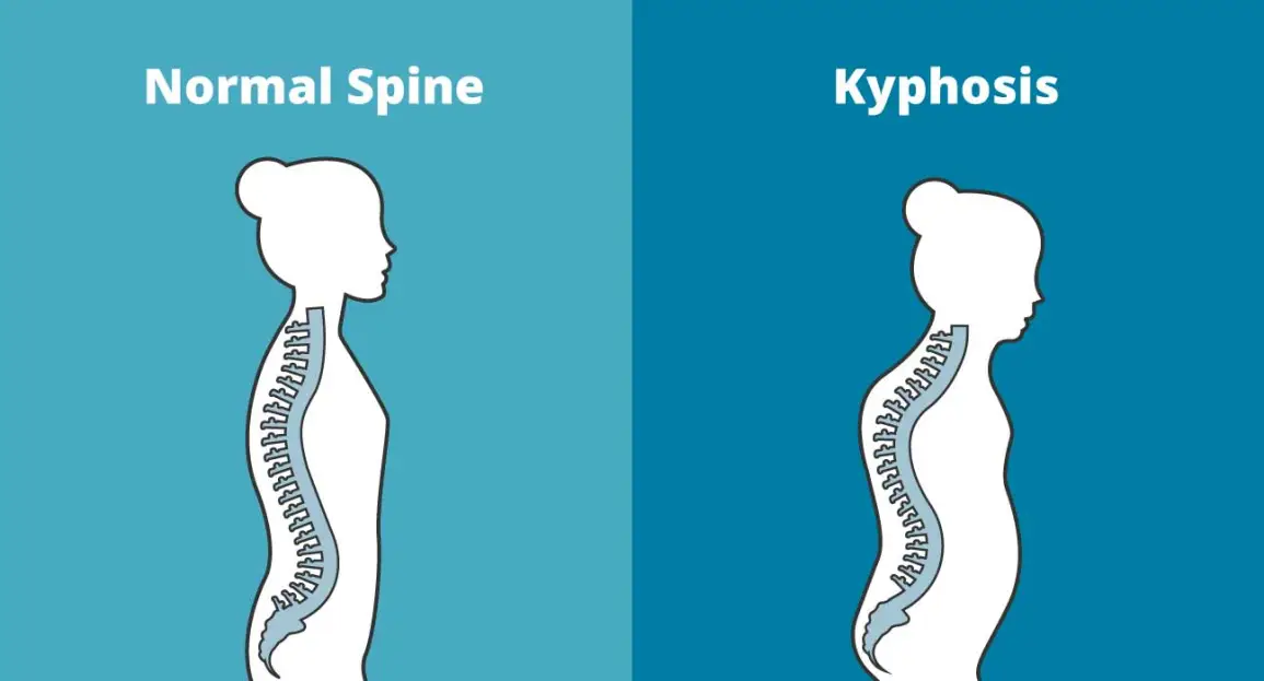 Kyphosis Treatment