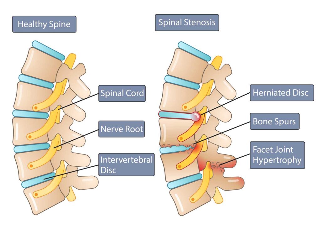 Lumbar Canal Stenosis