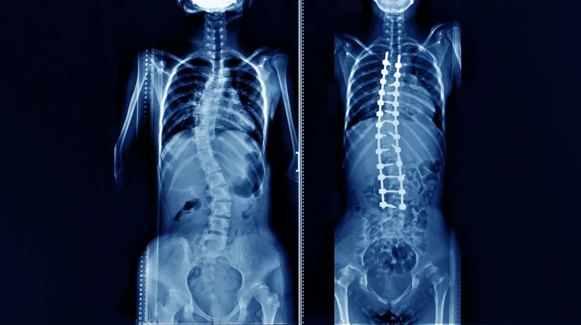 Scoliosis Surgery