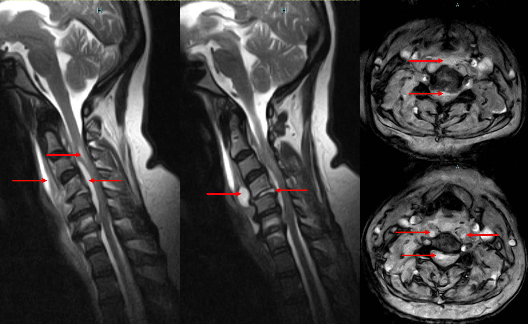 Spinal Infections/ Tumours