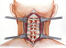 Cervical Spine Surgery in Nagpur