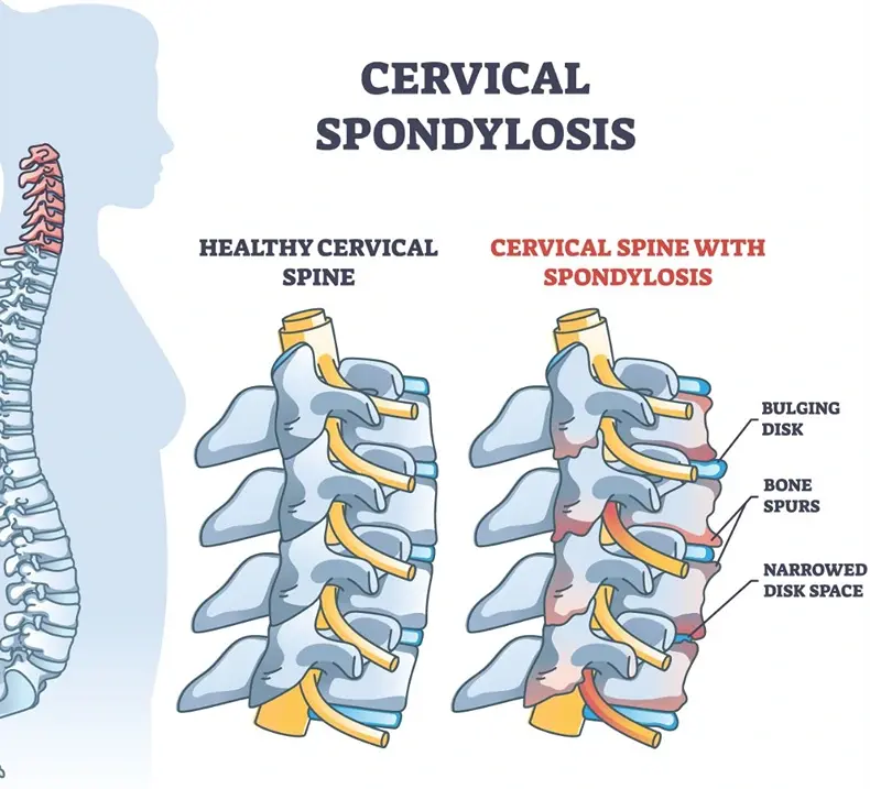 Cervical Spondylosis Doctor In Nagpur
