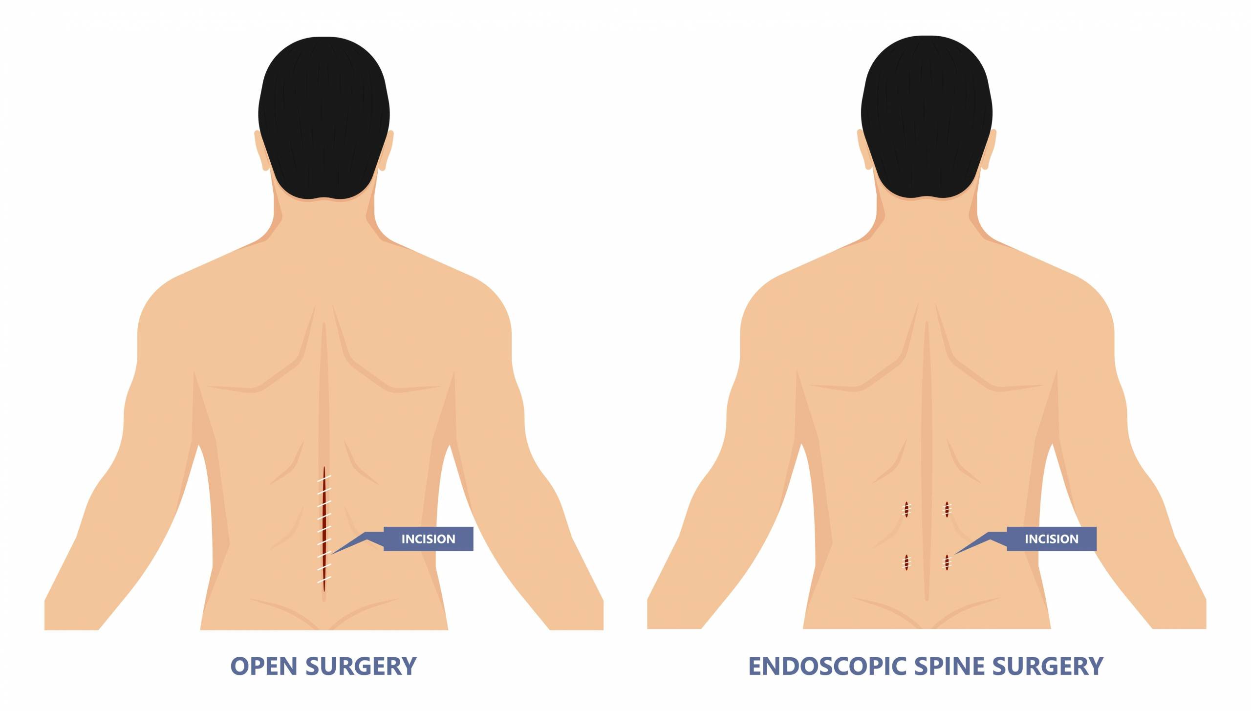 Endoscopic Spine Surgery In Gondia