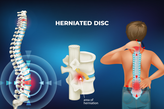 Herniated Disc Specialist In Nagpur