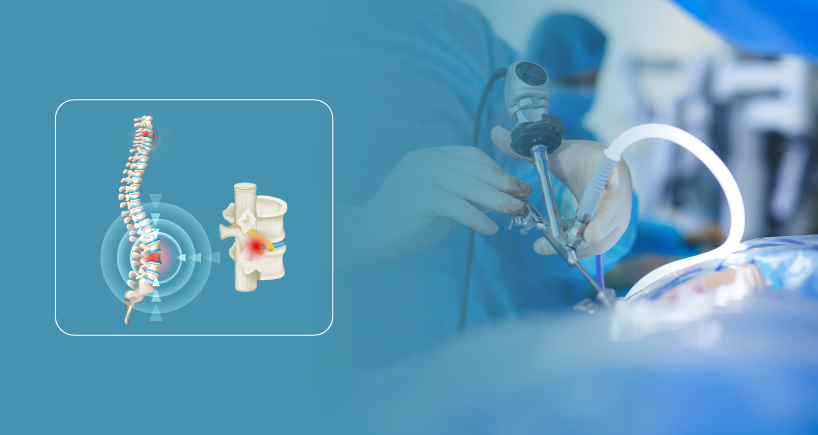 Keyhole Spine Surgery In Satna