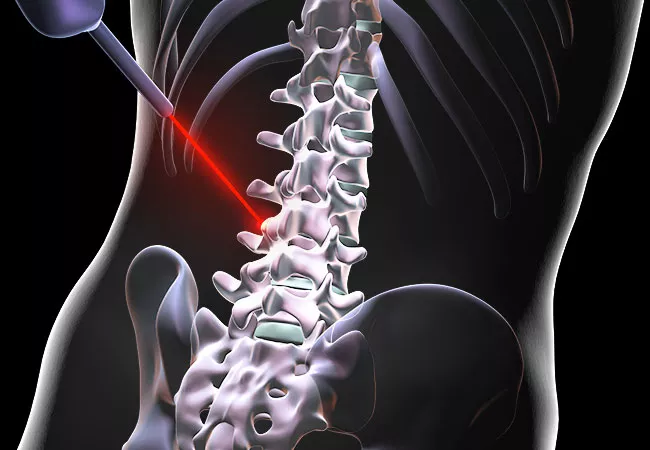 Laser Spine Surgery Doctor In Chhindwara
