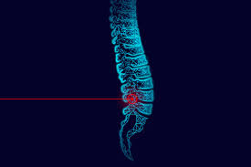 Laser Spine Surgery Doctor In Nagpur