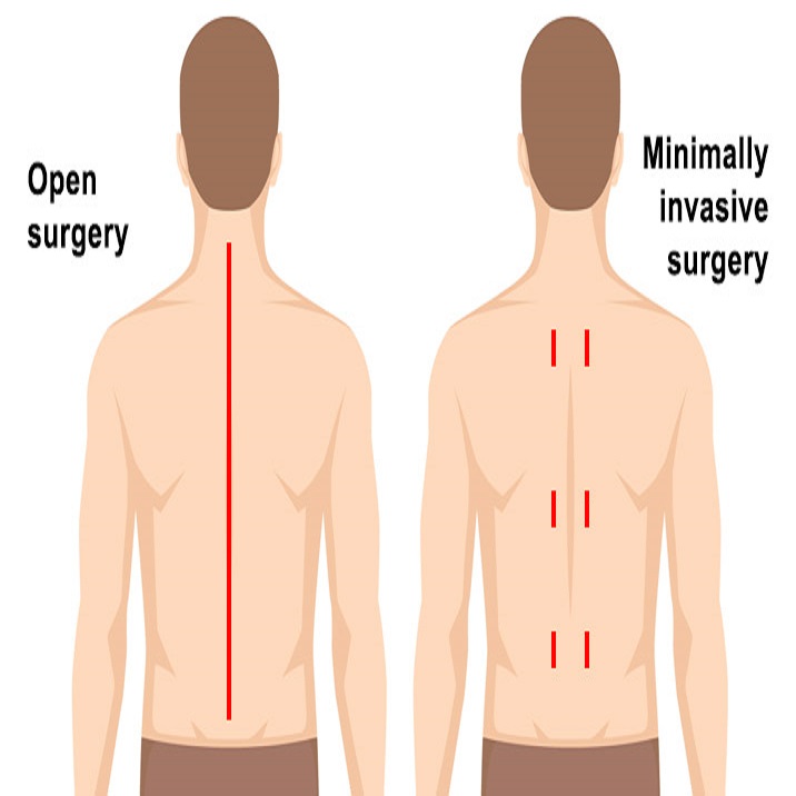 Minimally Invasive Spine Surgery In Gondia