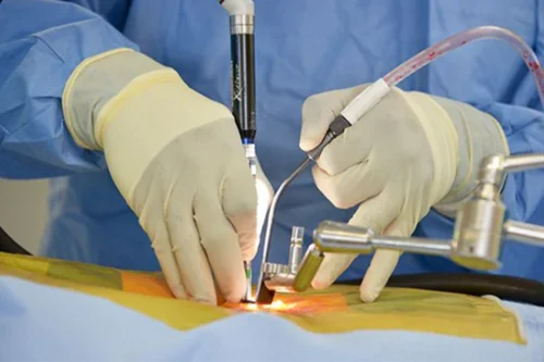Minimally Invasive Spine Surgery In Jabalpur