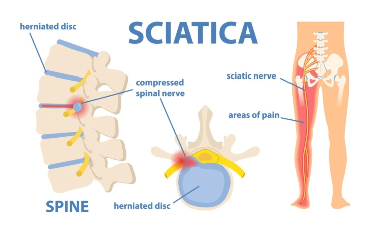 Sciatica Pain Doctor In Nagpur