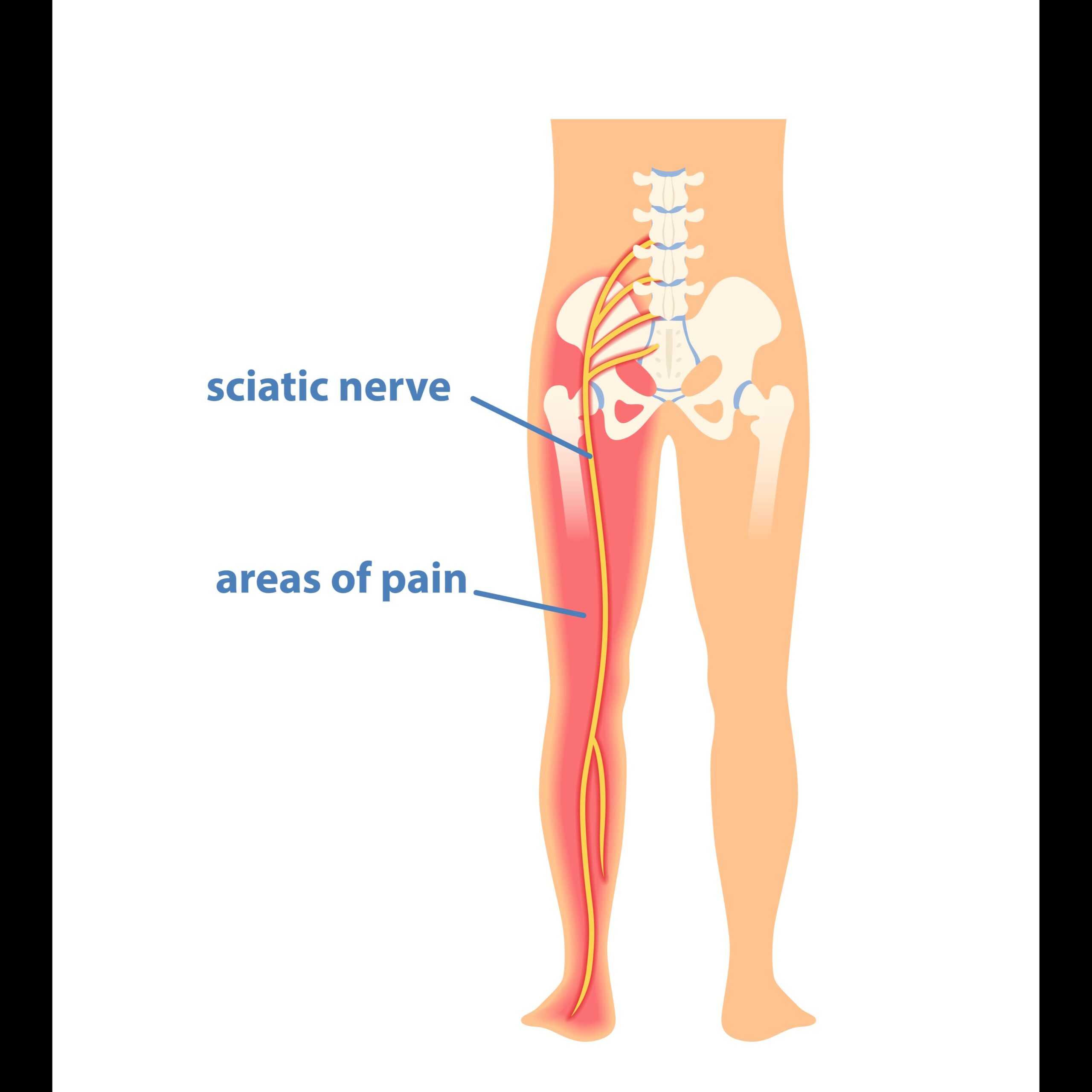 Sciatica Pain Treatment In Nagpur