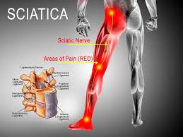 Sciatica Treatment Doctor In Nagpur