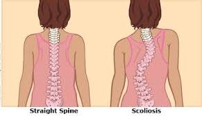 Scoliosis Treatment Doctor In Nagpur
