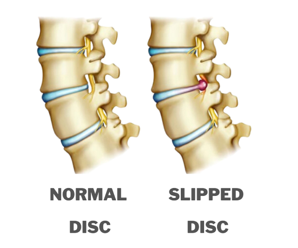 Slip Disc Treatment Doctor In Nagpur