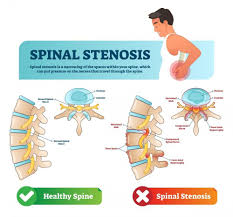 Spinal Stenosis Treatment Specialist In Nagpur