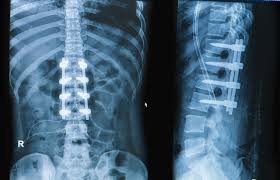 Spine Fusion Surgery Doctor in Nagpur