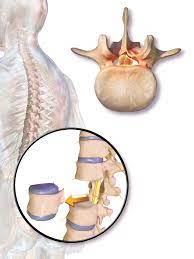 Spine Surgery Cost In Nagpur