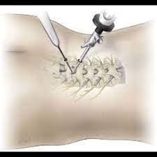 Spine Surgery Endoscopic In Raipur