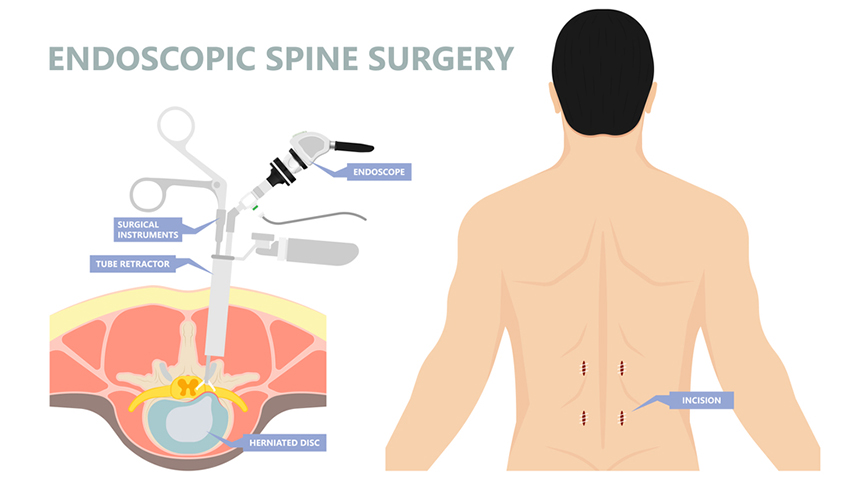 Spine Surgery Endoscopic In Seoni​
