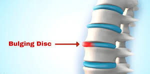Spine Surgery For Bulging Disc In Nagpur