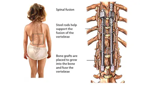 Spine Surgery Fusion In Wardha