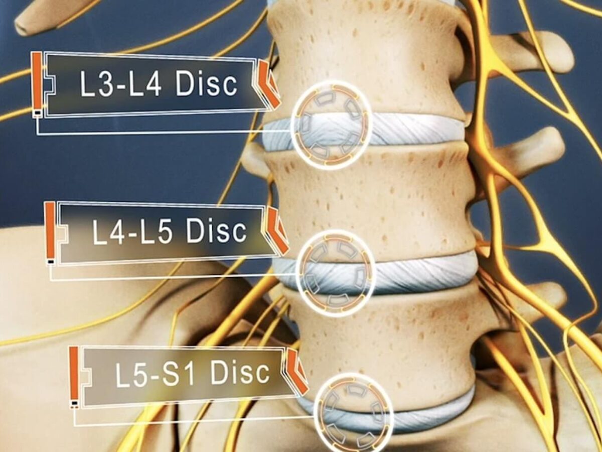 Spine Surgery L4 L5 In Durg