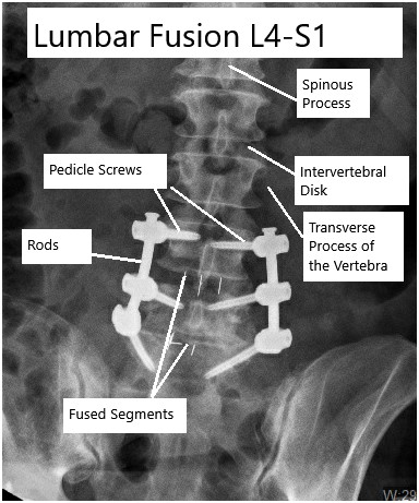 Spine Surgery L4 L5 In Yavatmal