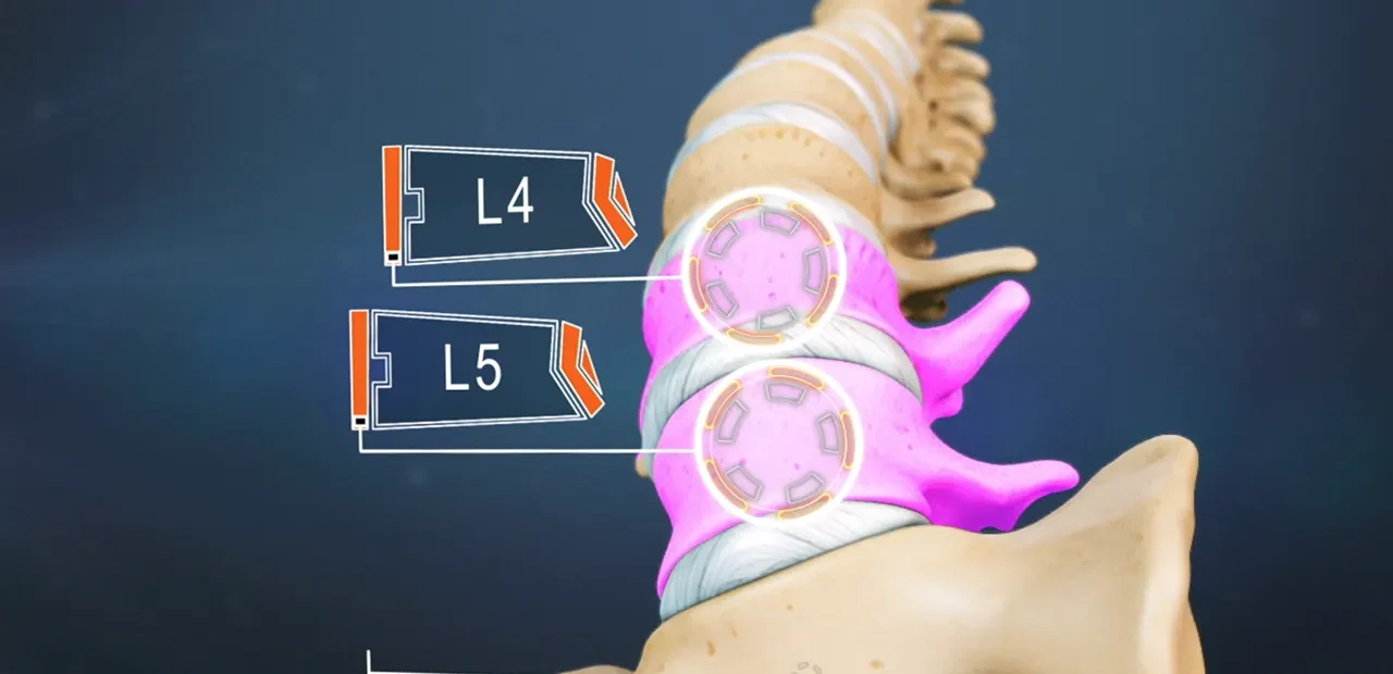 Spine Surgery L4 L5 in Wardha