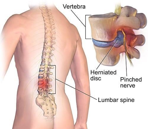 Spine Surgery Lumbar In Nagpur