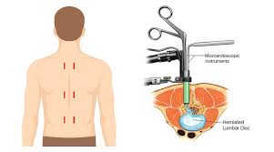 Endoscopic Spine Surgery In Chhattisgarh