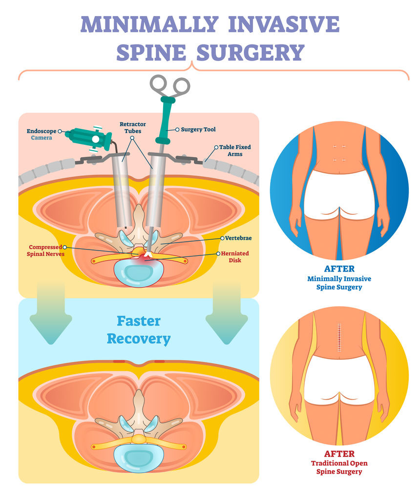 Spine Surgery Minimally Invasive In Satna