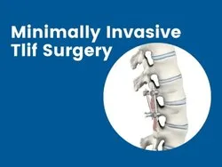 Spine Surgery TLIF in Nagpur