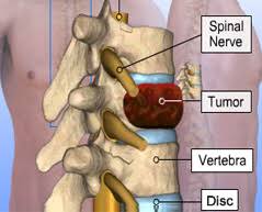 Spine Tumour Surgery In Nagpur