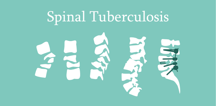 Surgery For Spinal Tuberculosis In Nagpur