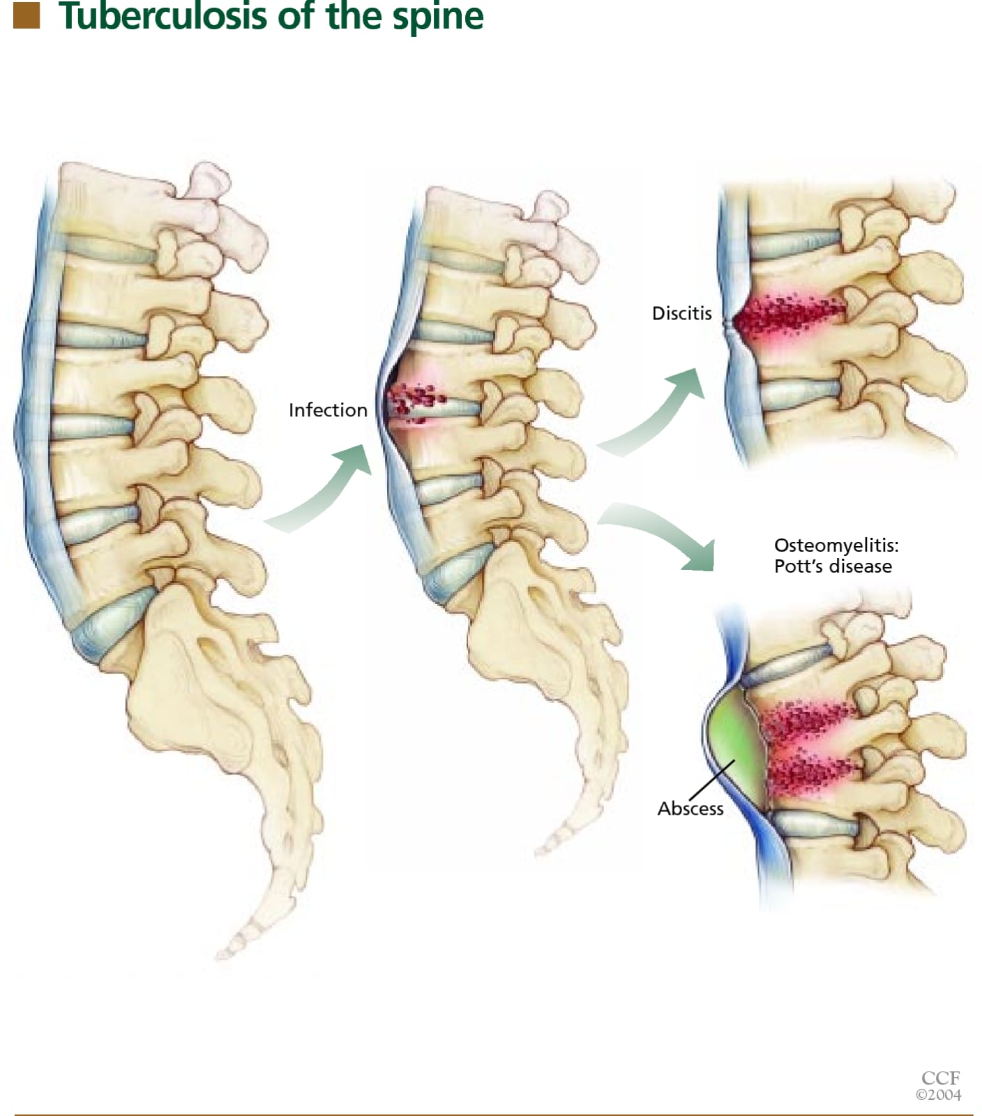 Tuberculosis Of The Spine Treatment In Chandrapur
