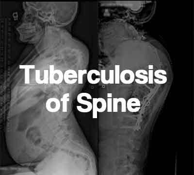 Tuberculosis Of The Spine Treatment In Jabalpur