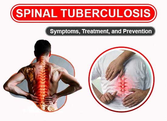 Tuberculosis Of The Spine Treatment In Wardha