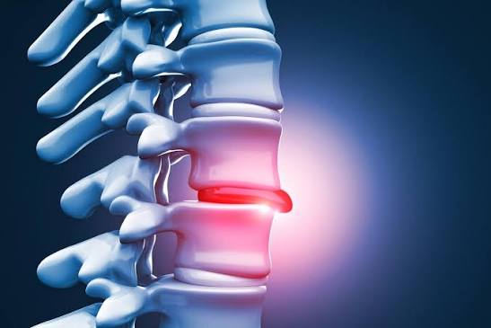 Herniated Disc Specialist In Nagpur