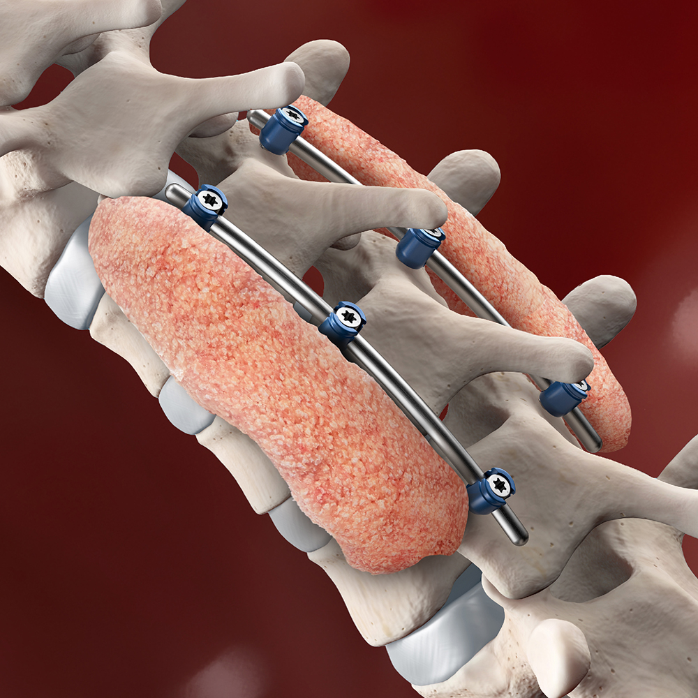 Spine Surgery For Bulging Disc In Nagpur