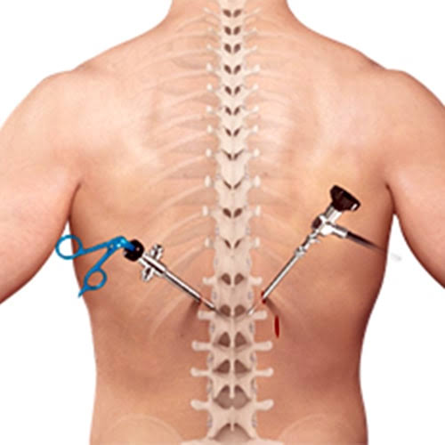 Spine Surgery Minimally Invasive In Nagpur