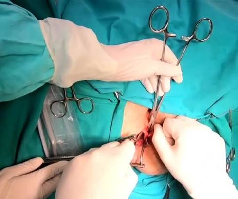 Tssula Surgery In Nagpur